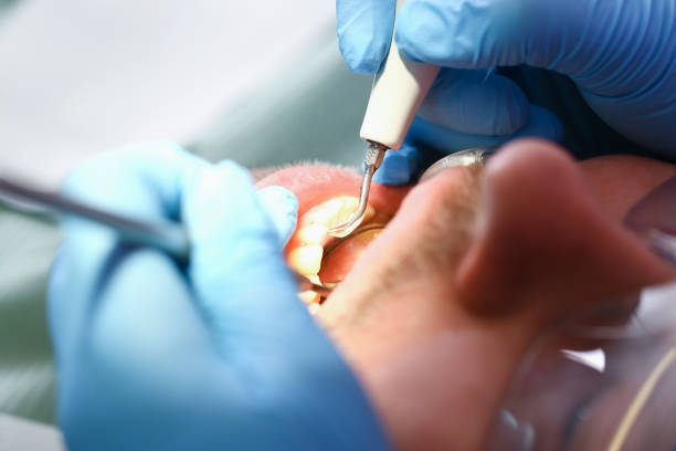 Best Cracked Tooth Emergency Dentist  in Beacon Square, FL